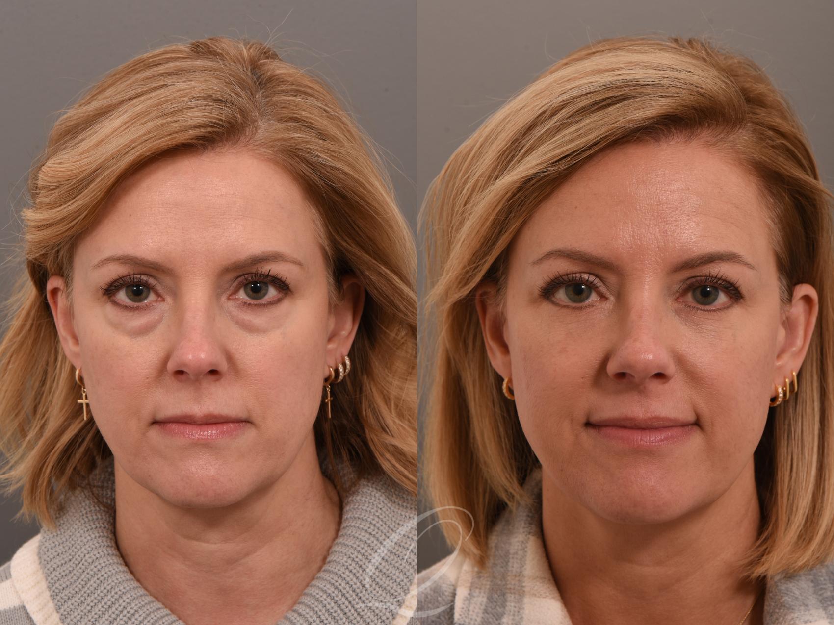 before-after